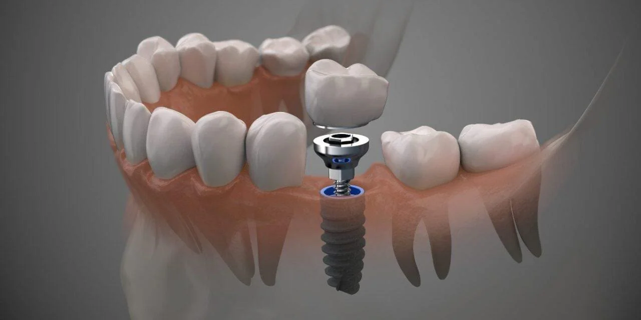 Dental Implants