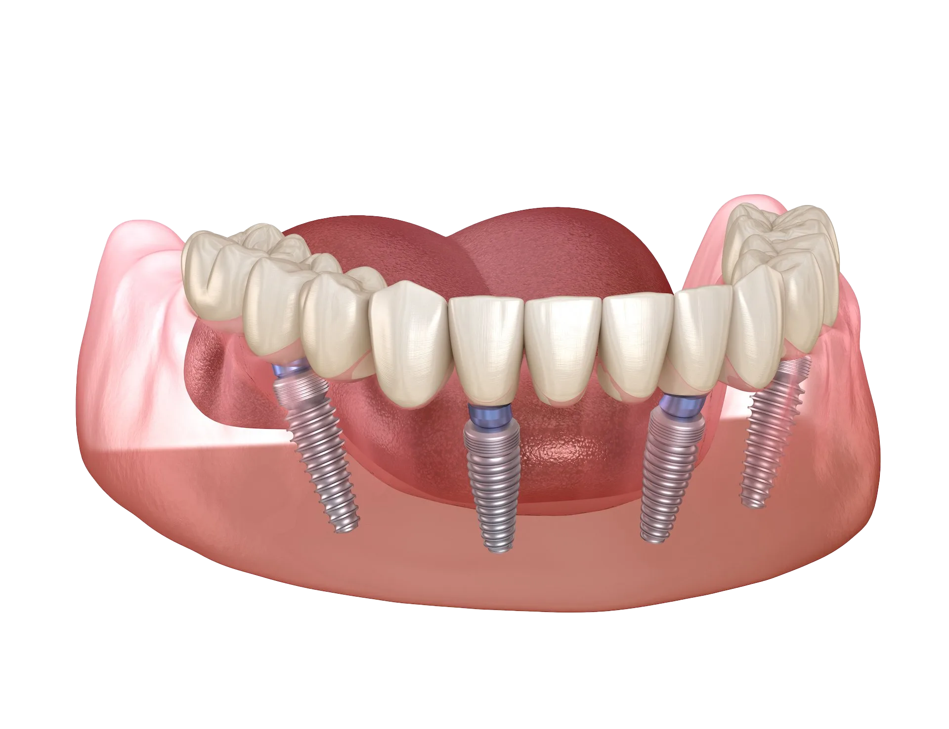 All- On- 4 Implants
