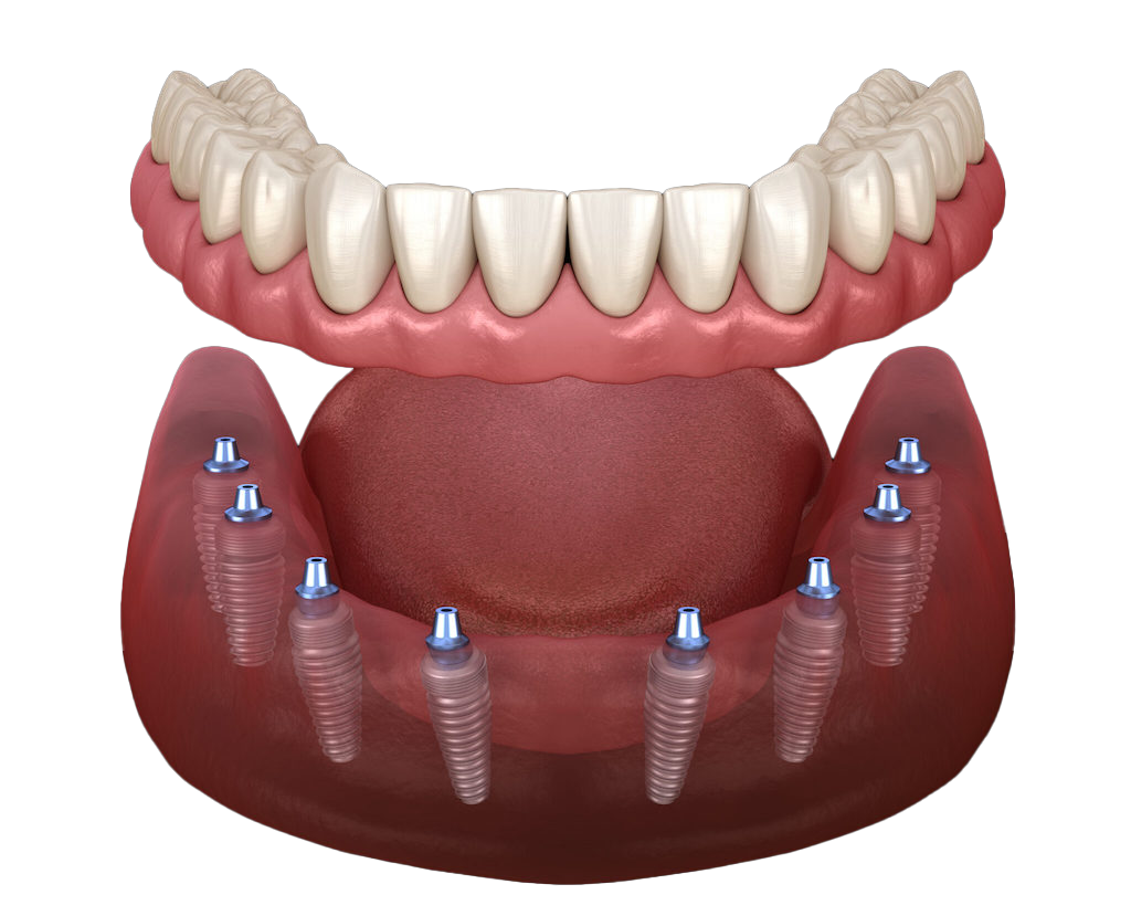 All- On- 8 Implants