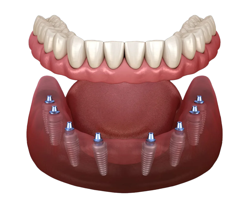 All- On- 8 Implants