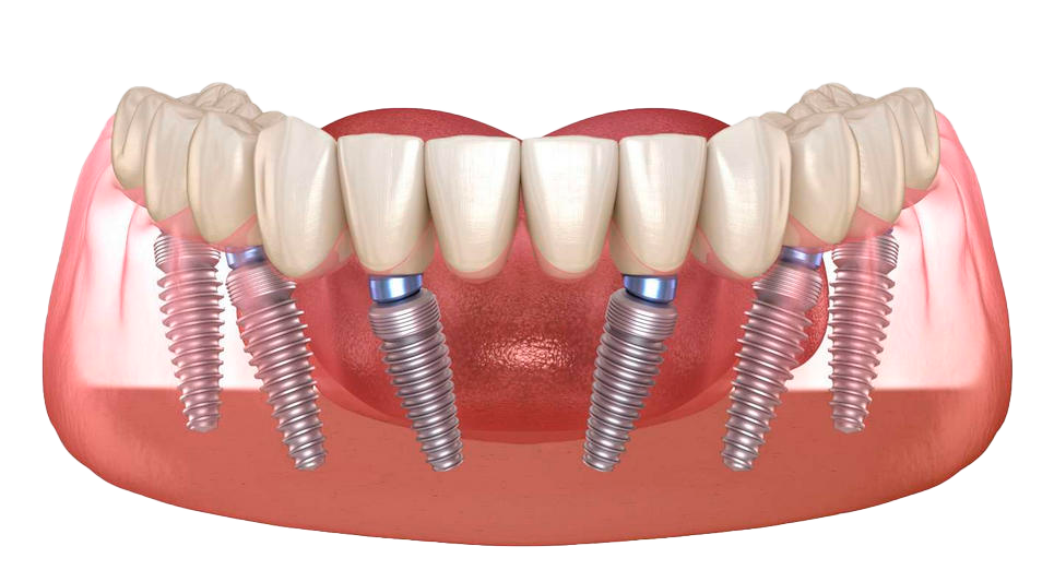 All- On- 6 Implants