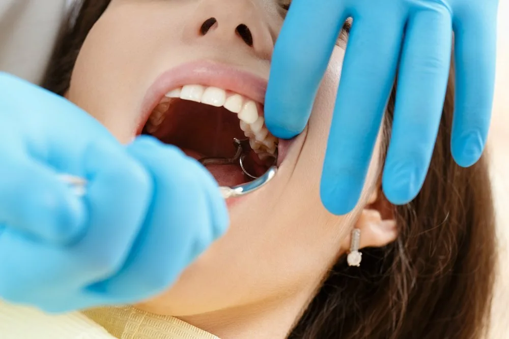 Wisdom Teeth Removal - dental of Aventura