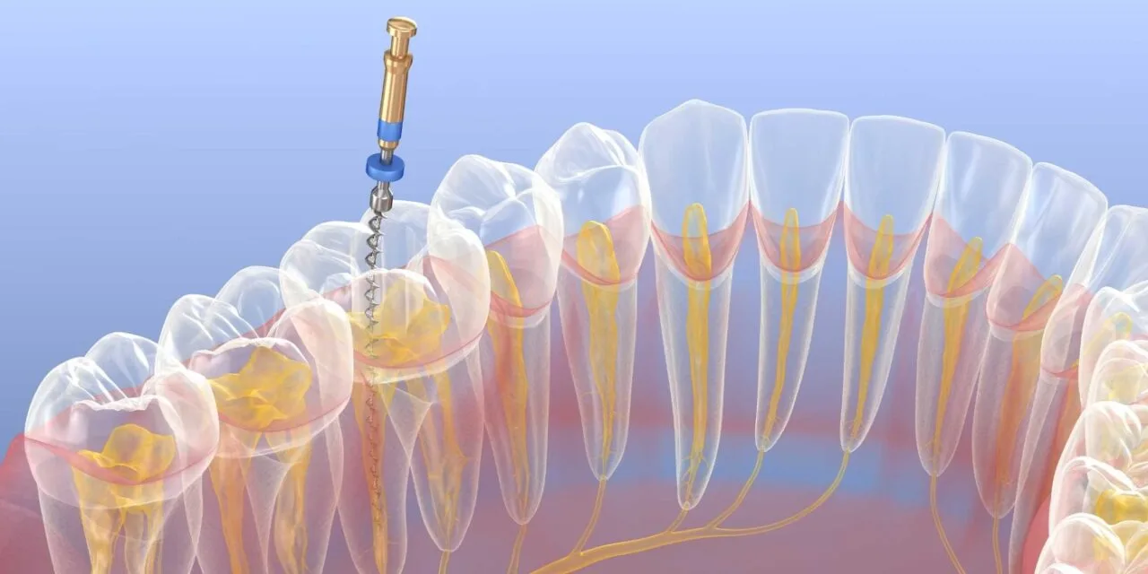 Affordable Root Canal Treatment at Dentist of Aventura
