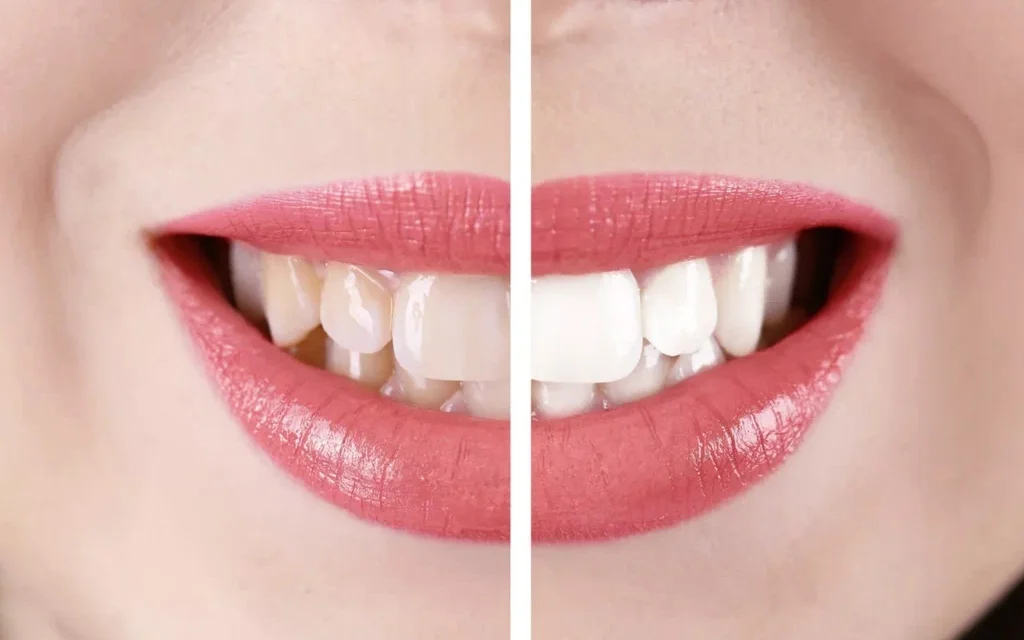 Venus Max Whitening