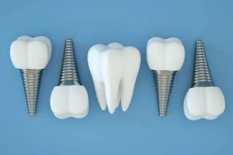 One-Day Dental Implants in Aventura