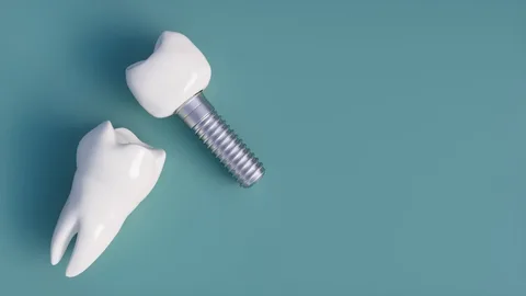 Implantes Dentales Cerca de Mí