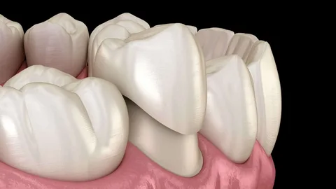 Zirconia Dental Crowns in Aventura