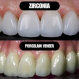 Zirconia vs Porcelain Crown