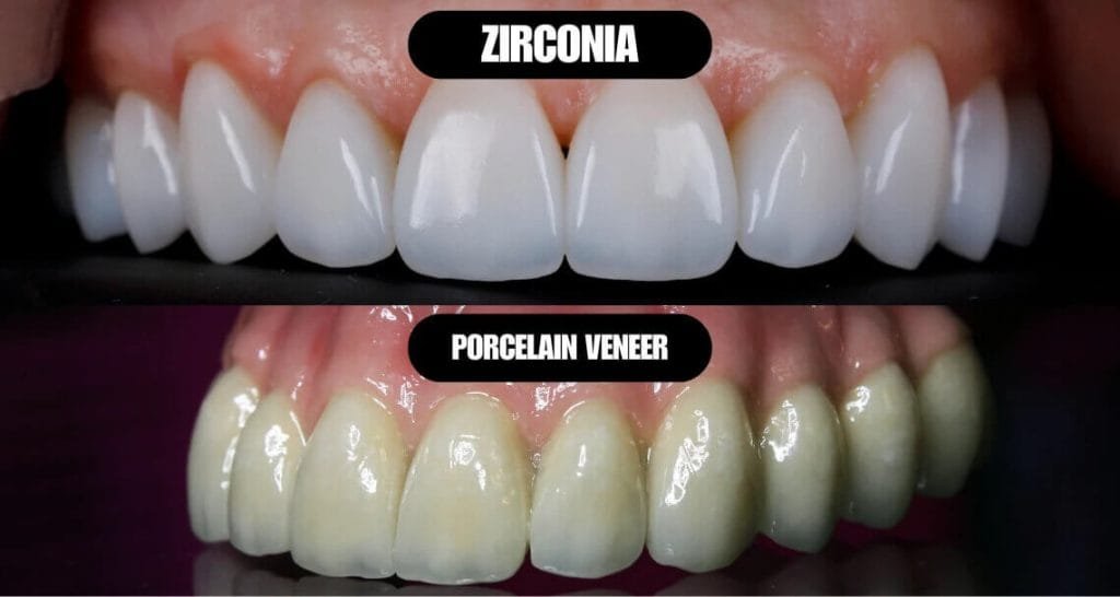 Zirconia vs Porcelain Crown: Aventura Dentist Honest Comparison