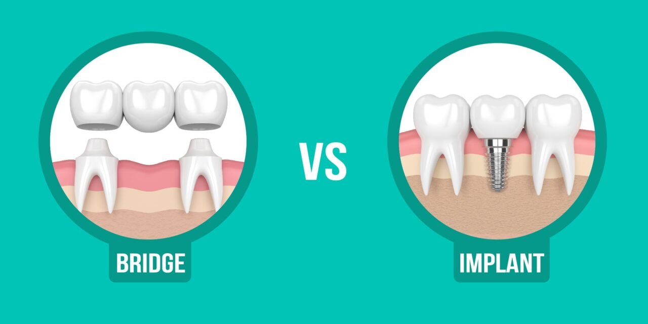 Dental Implant vs Dental Bridge: An Aventura Dentist Explains the Right Choice
