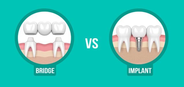 Dental Implant vs Dental Bridge: An Aventura Dentist Explains the Right Choice 1 Dental Implant vs Dental Bridge