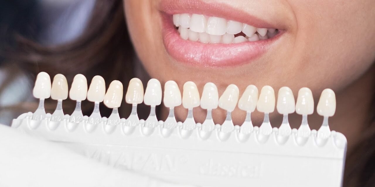 How Much Do Porcelain Veneers Cost in Aventura, FL? (2026 Honest Pricing)