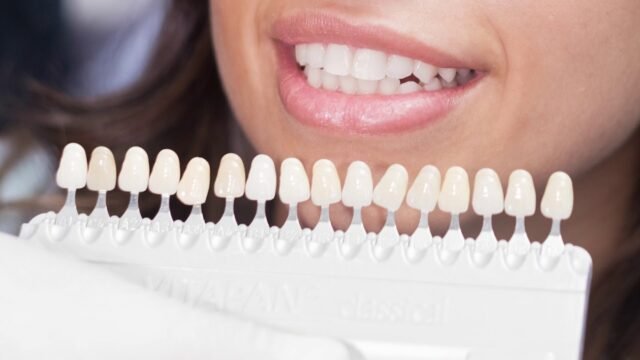 Porcelain Veneers