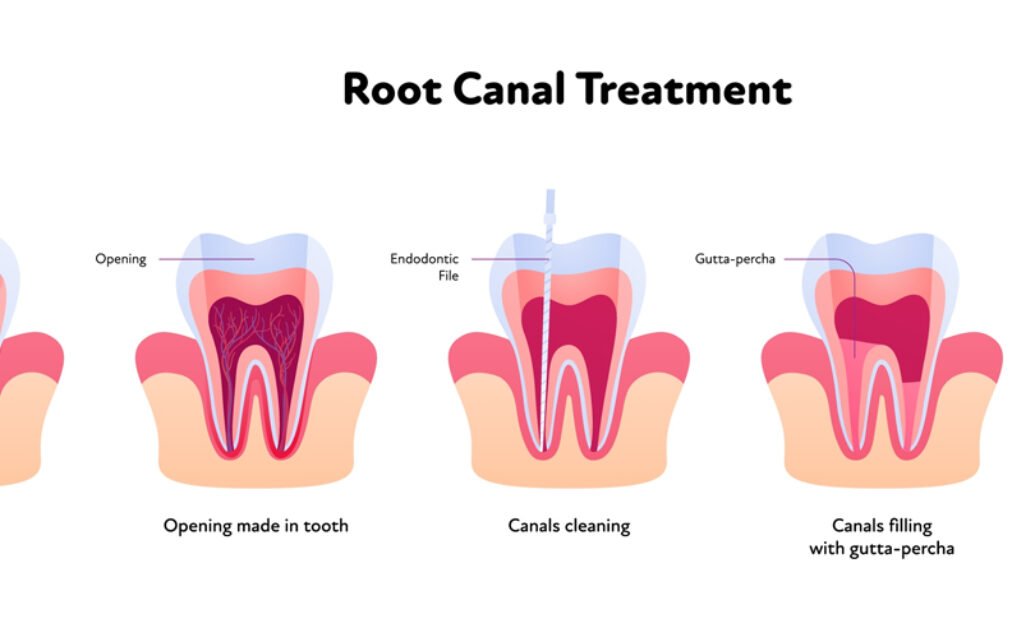 Is a Root Canal Painful? An Aventura Dentist Answers Honestly (Step-by-Step)