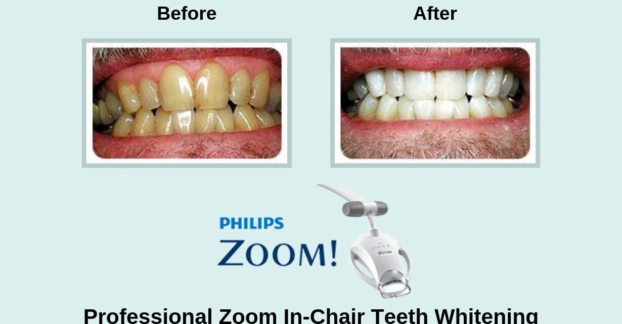 Zoom Whitening vs At-Home Kits: Which Actually Works?
