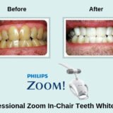 Zoom in chair teeth whitening