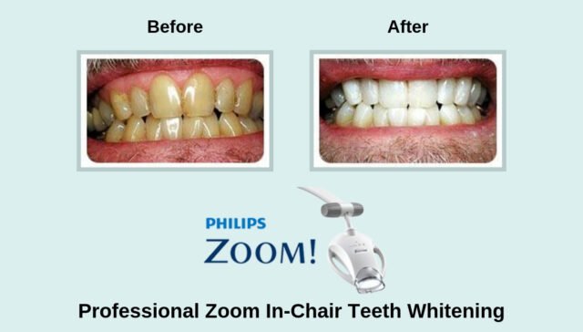 Zoom in chair teeth whitening