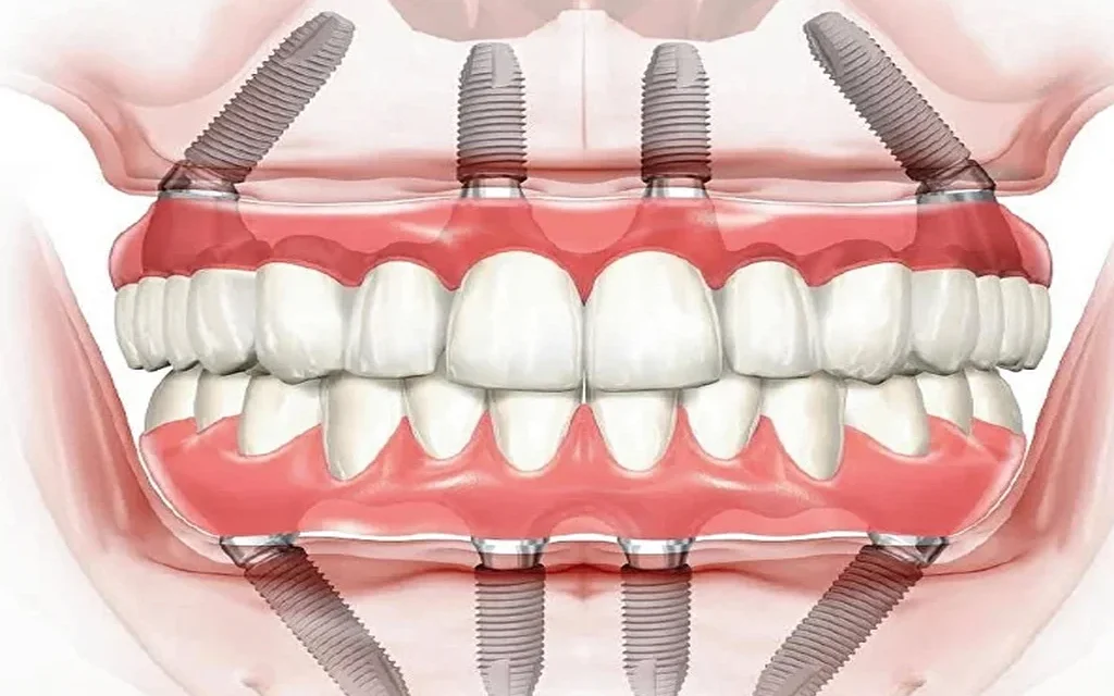 All-on-4 vs All-on-6 vs All-on-X in Aventura: Which Full-Arch Implant Is Right for You?